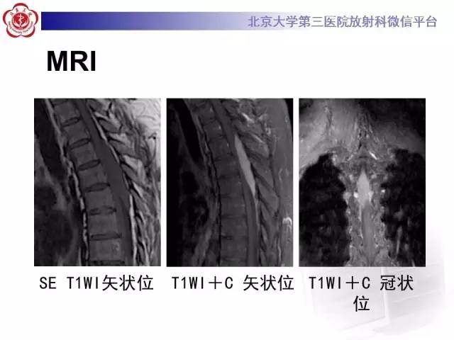 【病例】脊柱原发性硬膜外淋巴瘤1例MR
