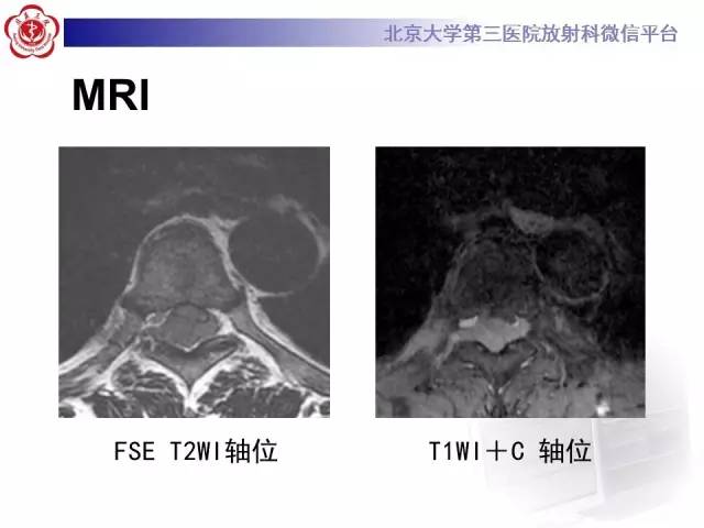 【病例】脊柱原发性硬膜外淋巴瘤1例MR
