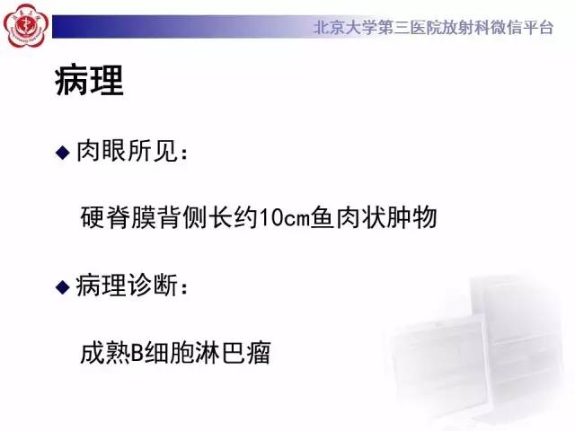 【病例】脊柱原发性硬膜外淋巴瘤1例MR