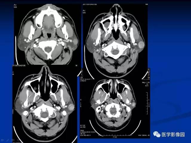 【病例】左腮腺腺淋巴瘤1例CT影像表现