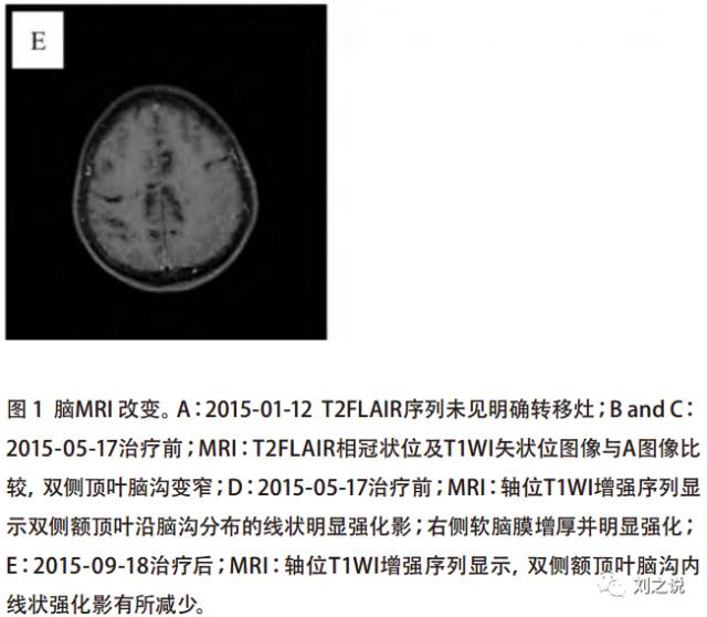 十张图快速了解肿瘤脑膜转移影像学特点 十张图快速了解肿瘤脑膜转移影像学特点