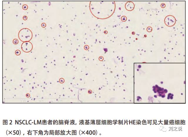 十张图快速了解肿瘤脑膜转移影像学特点 十张图快速了解肿瘤脑膜转移影像学特点