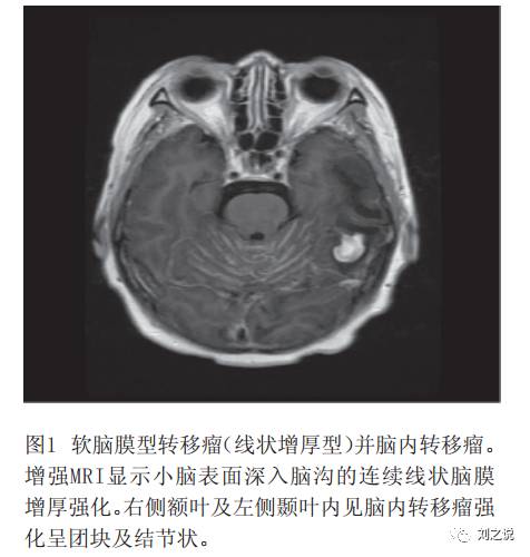 十张图快速了解肿瘤脑膜转移影像学特点 十张图快速了解肿瘤脑膜转移影像学特点