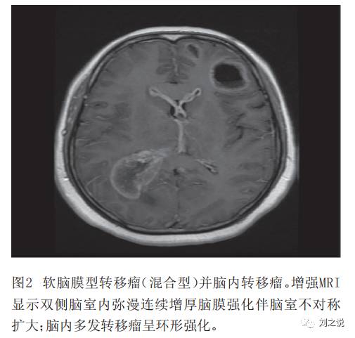 十张图快速了解肿瘤脑膜转移影像学特点 十张图快速了解肿瘤脑膜转移影像学特点