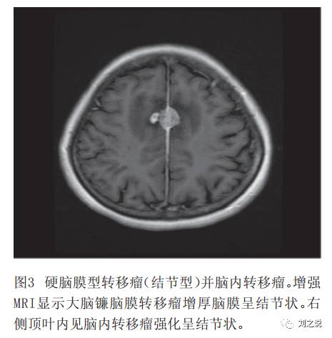 十张图快速了解肿瘤脑膜转移影像学特点 十张图快速了解肿瘤脑膜转移影像学特点