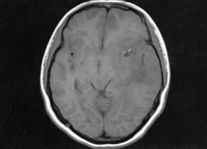 【病例】左颞叶混合性少突星形细胞瘤1例MR影像解析