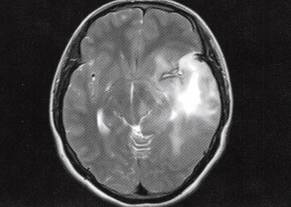 【病例】左颞叶混合性少突星形细胞瘤1例MR影像解析