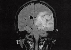 【病例】左颞叶混合性少突星形细胞瘤1例MR影像解析
