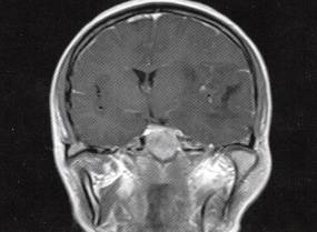 【病例】左颞叶混合性少突星形细胞瘤1例MR影像解析
