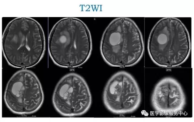 【病例】在影像读片中寻找“蛛丝马迹”——一例常见不典型肿瘤的定位及定性 【病例】在影像读片中寻找“蛛丝马迹”——一例常见不典型肿瘤的定位及定性