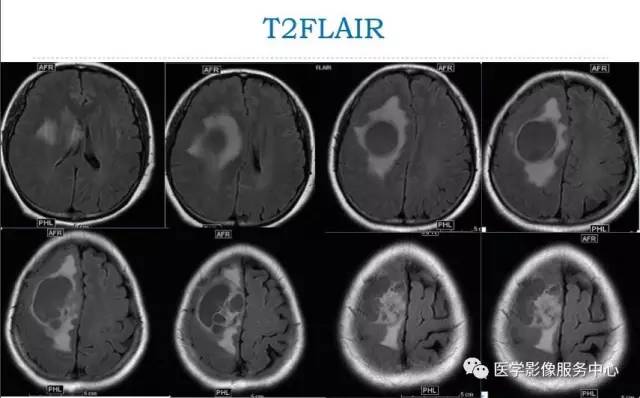 【病例】在影像读片中寻找“蛛丝马迹”——一例常见不典型肿瘤的定位及定性 【病例】在影像读片中寻找“蛛丝马迹”——一例常见不典型肿瘤的定位及定性