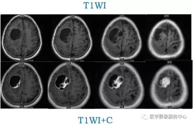 【病例】在影像读片中寻找“蛛丝马迹”——一例常见不典型肿瘤的定位及定性 【病例】在影像读片中寻找“蛛丝马迹”——一例常见不典型肿瘤的定位及定性