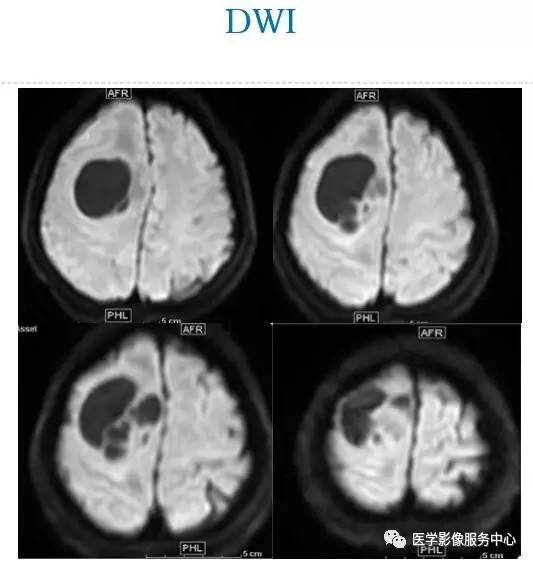 【病例】在影像读片中寻找“蛛丝马迹”——一例常见不典型肿瘤的定位及定性 【病例】在影像读片中寻找“蛛丝马迹”——一例常见不典型肿瘤的定位及定性