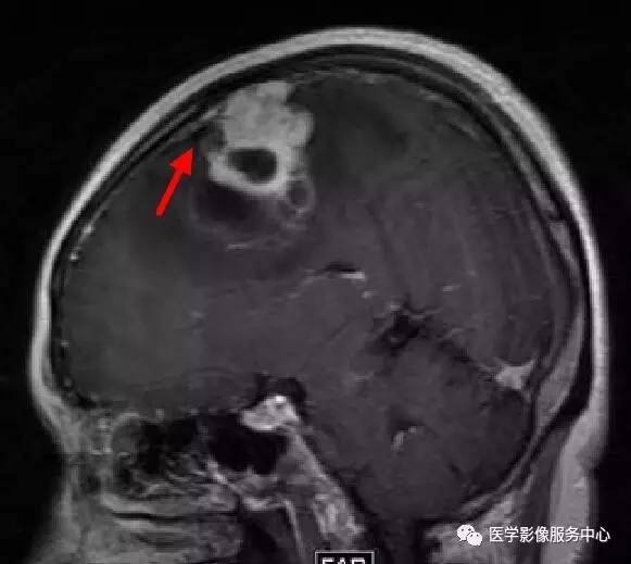 【病例】在影像读片中寻找“蛛丝马迹”——一例常见不典型肿瘤的定位及定性 【病例】在影像读片中寻找“蛛丝马迹”——一例常见不典型肿瘤的定位及定性