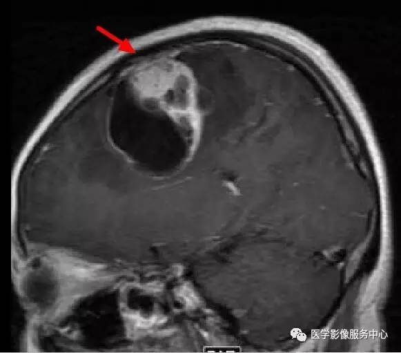 【病例】在影像读片中寻找“蛛丝马迹”——一例常见不典型肿瘤的定位及定性 【病例】在影像读片中寻找“蛛丝马迹”——一例常见不典型肿瘤的定位及定性