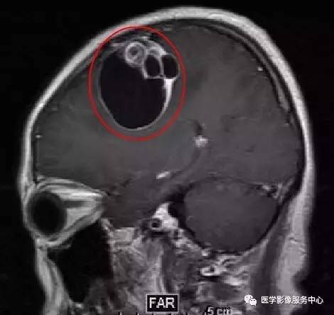【病例】在影像读片中寻找“蛛丝马迹”——一例常见不典型肿瘤的定位及定性