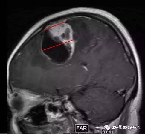 【病例】在影像读片中寻找“蛛丝马迹”——一例常见不典型肿瘤的定位及定性 【病例】在影像读片中寻找“蛛丝马迹”——一例常见不典型肿瘤的定位及定性