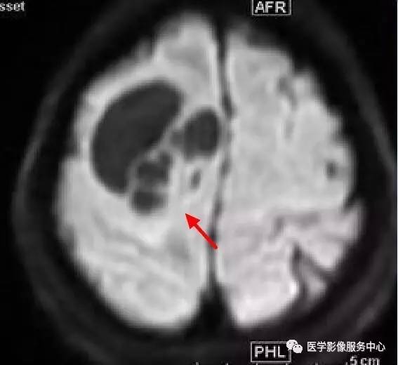【病例】在影像读片中寻找“蛛丝马迹”——一例常见不典型肿瘤的定位及定性 【病例】在影像读片中寻找“蛛丝马迹”——一例常见不典型肿瘤的定位及定性