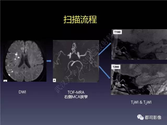 【PPT】颅内动脉粥样硬化高分辨MRI与临床