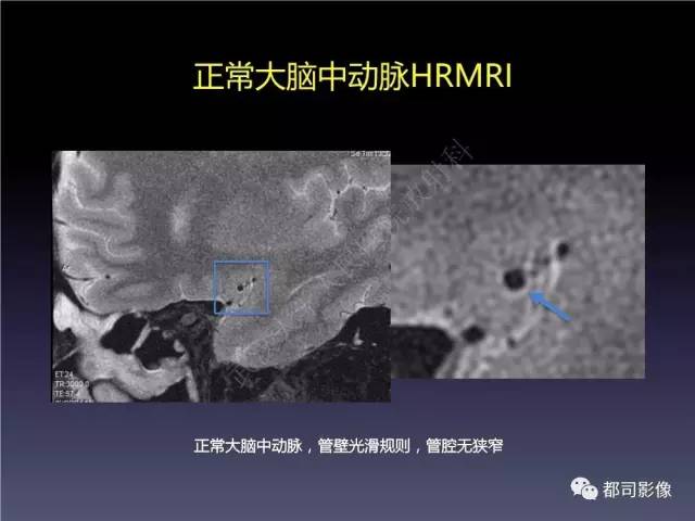 【PPT】颅内动脉粥样硬化高分辨MRI与临床