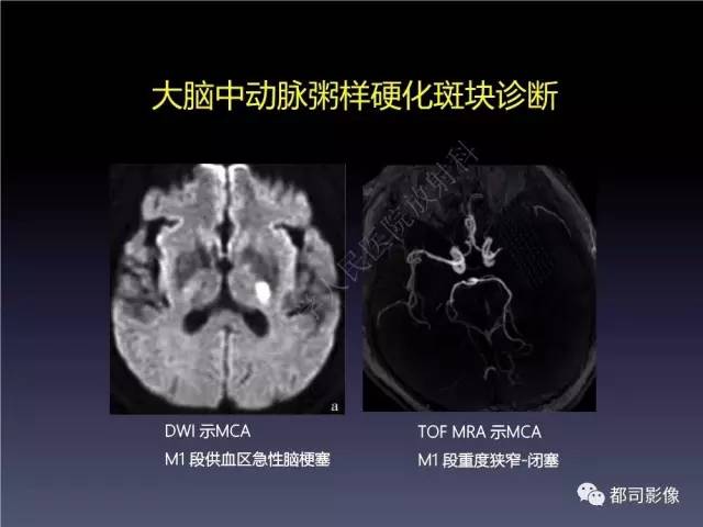 【PPT】颅内动脉粥样硬化高分辨MRI与临床