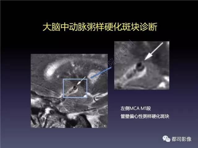 【PPT】颅内动脉粥样硬化高分辨MRI与临床