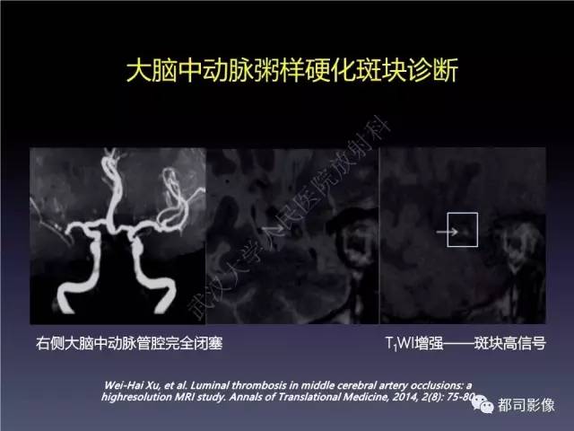 【PPT】颅内动脉粥样硬化高分辨MRI与临床