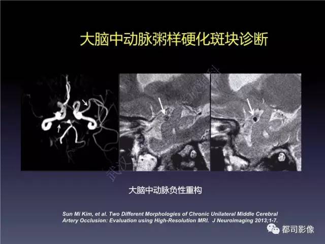 【PPT】颅内动脉粥样硬化高分辨MRI与临床