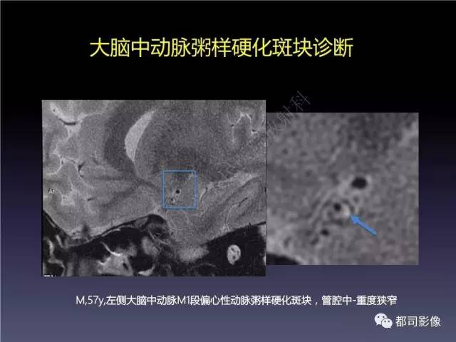 【PPT】颅内动脉粥样硬化高分辨MRI与临床