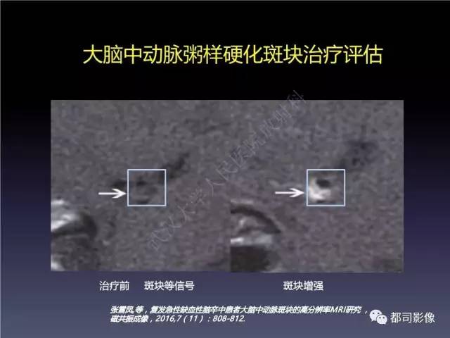 【PPT】颅内动脉粥样硬化高分辨MRI与临床