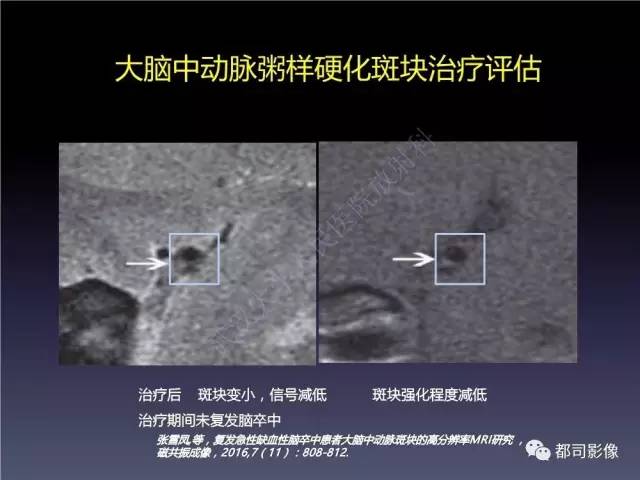 【PPT】颅内动脉粥样硬化高分辨MRI与临床