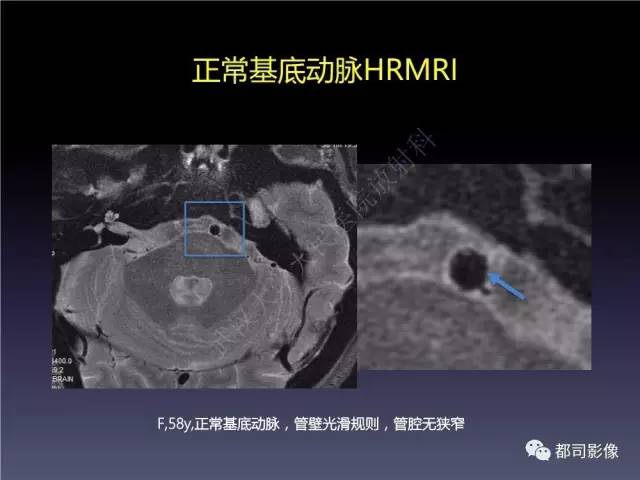 【PPT】颅内动脉粥样硬化高分辨MRI与临床