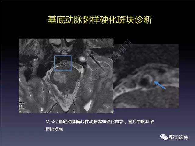 【PPT】颅内动脉粥样硬化高分辨MRI与临床
