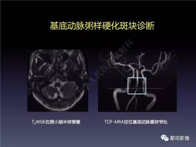 【PPT】颅内动脉粥样硬化高分辨MRI与临床