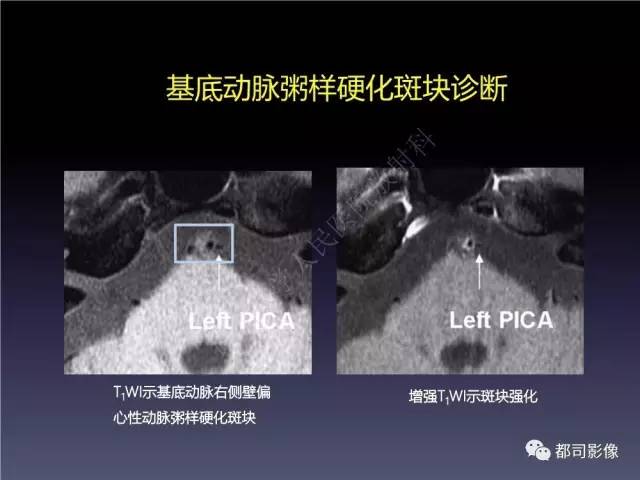 【PPT】颅内动脉粥样硬化高分辨MRI与临床
