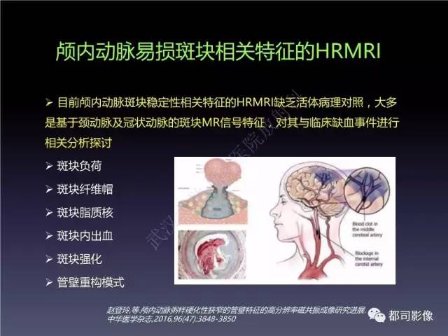 【PPT】颅内动脉粥样硬化高分辨MRI与临床