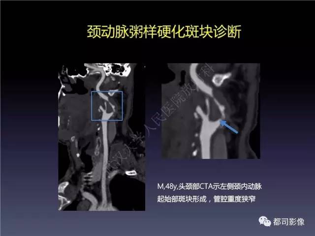 【PPT】颅内动脉粥样硬化高分辨MRI与临床