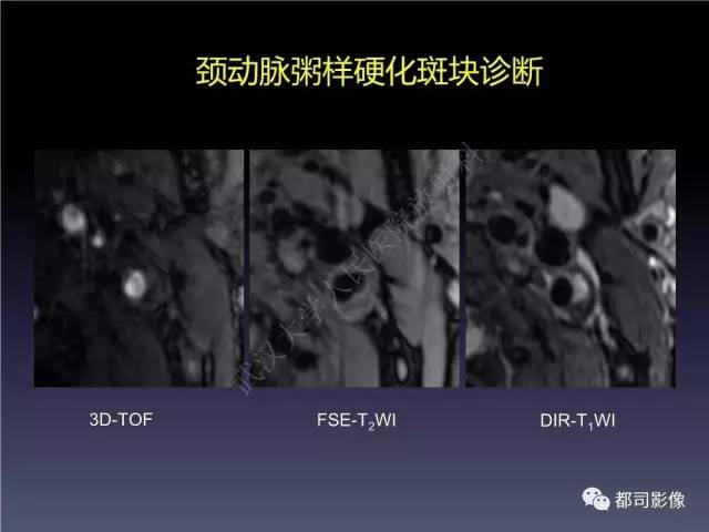 【PPT】颅内动脉粥样硬化高分辨MRI与临床