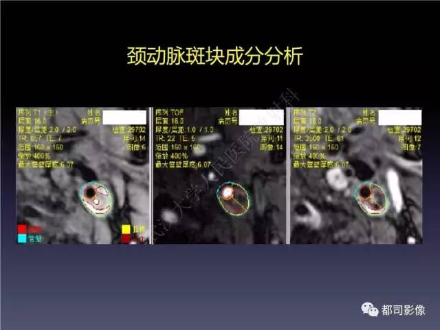【PPT】颅内动脉粥样硬化高分辨MRI与临床