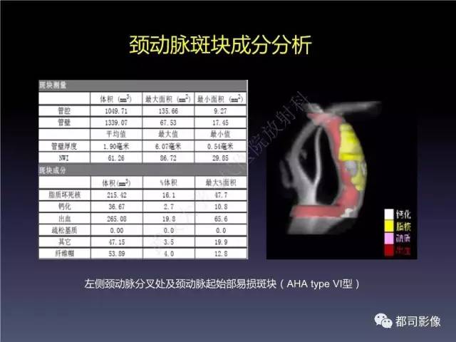 【PPT】颅内动脉粥样硬化高分辨MRI与临床