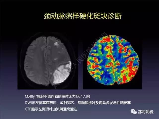 【PPT】颅内动脉粥样硬化高分辨MRI与临床