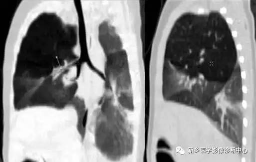 12种肺部发育异常,您知道几种? 12种肺部发育异常,您知道几种?