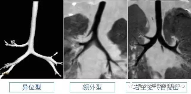 12种肺部发育异常,您知道几种? 12种肺部发育异常,您知道几种?