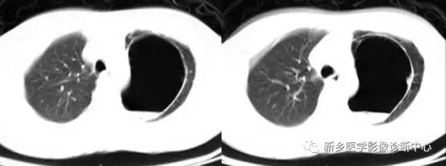 12种肺部发育异常,您知道几种? 12种肺部发育异常,您知道几种?