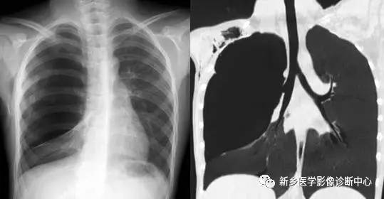 12种肺部发育异常,您知道几种? 12种肺部发育异常,您知道几种?