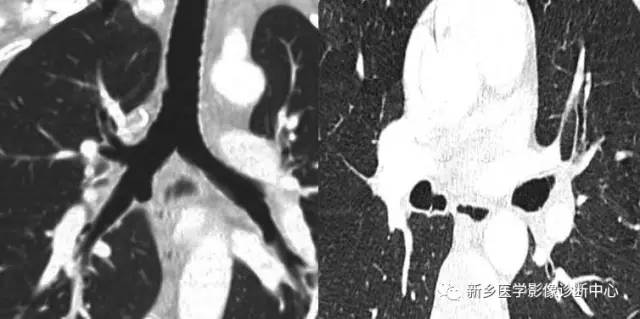 12种肺部发育异常,您知道几种? 12种肺部发育异常,您知道几种?