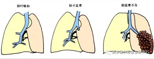 12种肺部发育异常,您知道几种? 12种肺部发育异常,您知道几种?