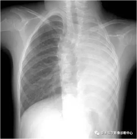 12种肺部发育异常,您知道几种? 12种肺部发育异常,您知道几种?