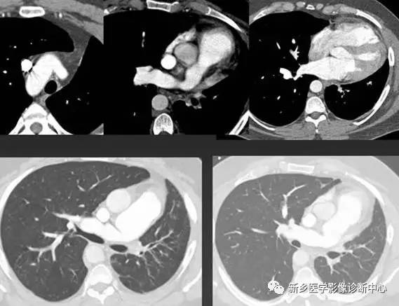 12种肺部发育异常,您知道几种? 12种肺部发育异常,您知道几种?