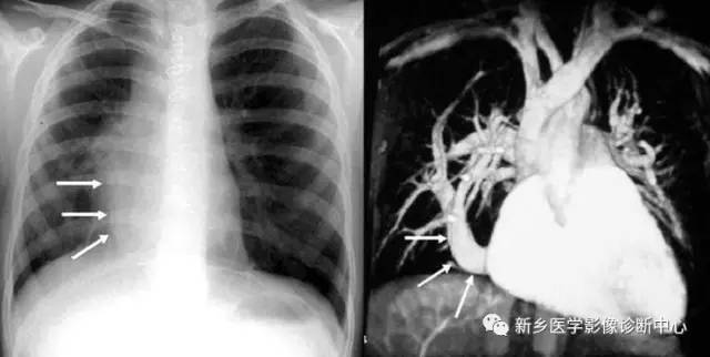 12种肺部发育异常,您知道几种? 12种肺部发育异常,您知道几种?